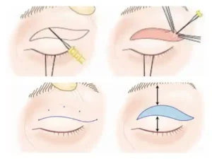 cirugia de parpados colombia