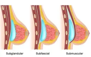 tecnicas de mamoplastia