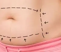 Abdominoplastia en Colombia Abdominoplastia en Colombia