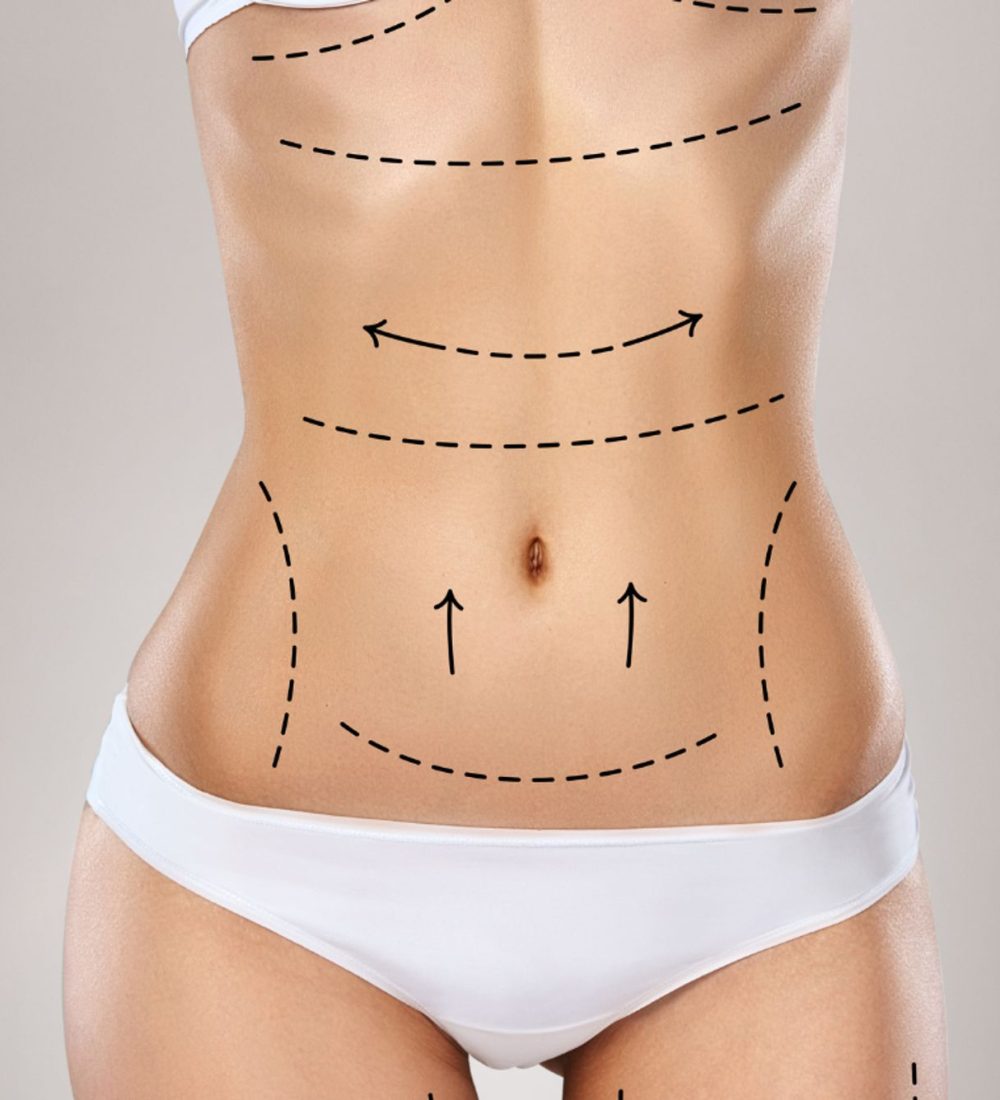 liposuccion1